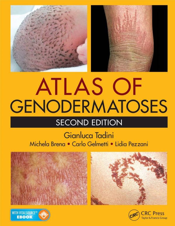 Atlas of Genodermatoses 2nd by Gianluca Tadini